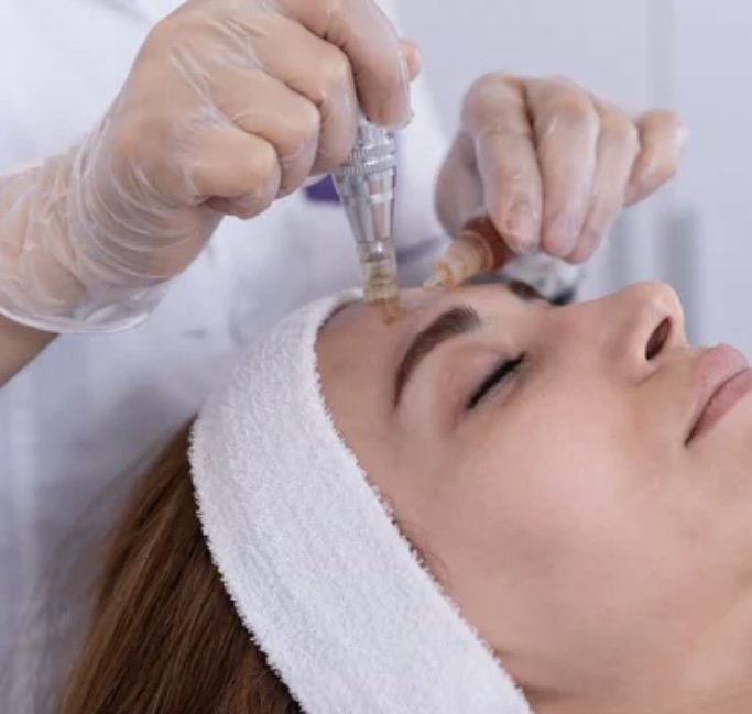 Microneedling + PRP