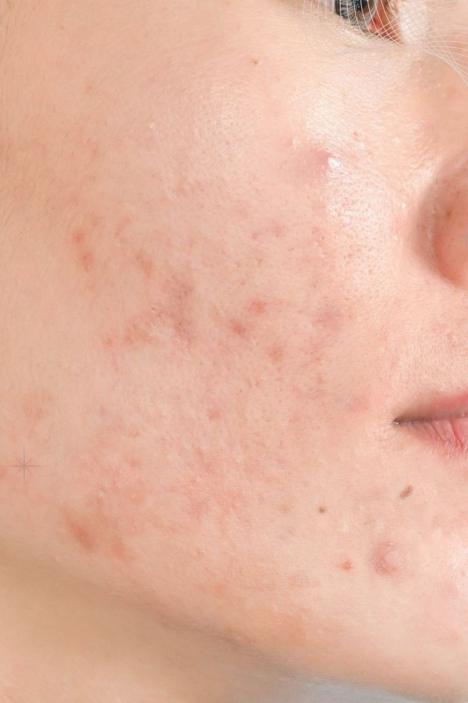 Acne Facial