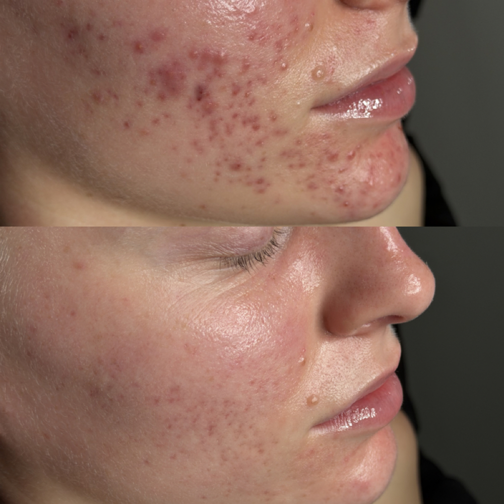 Active Acne Bootcamp Treatment at Aesthetics by Jenna in Loomis, CA