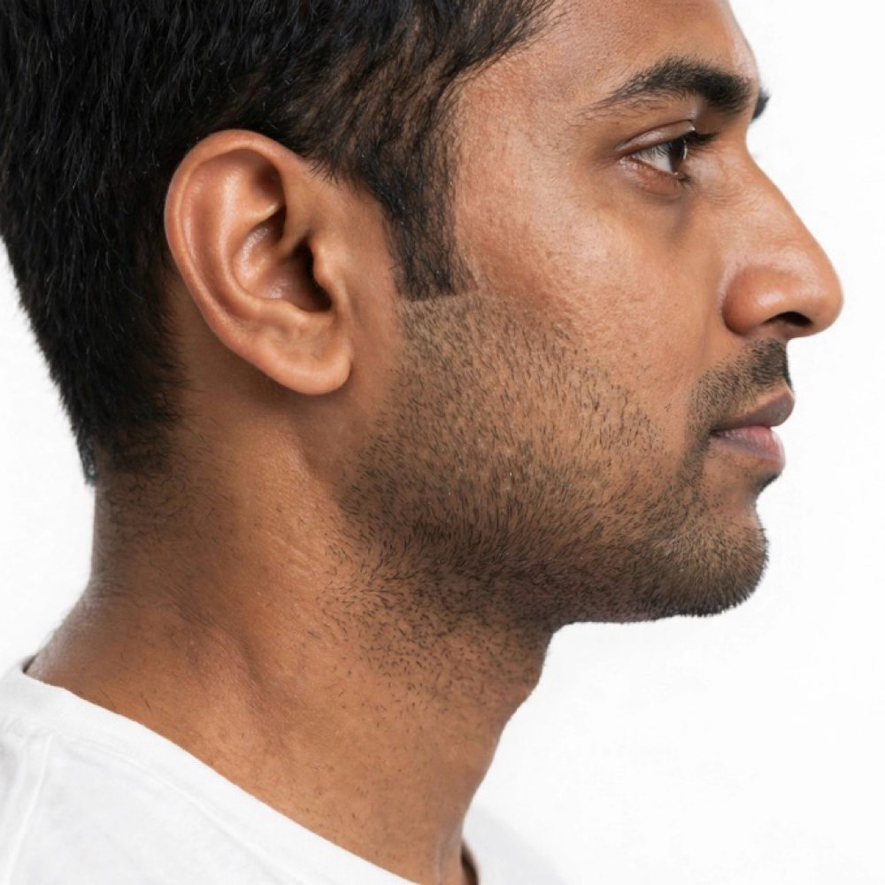 Full Beard Line + Neck/ 6 Sessions at EverBeauty Laser & Aesthetics in Argyle, TX
