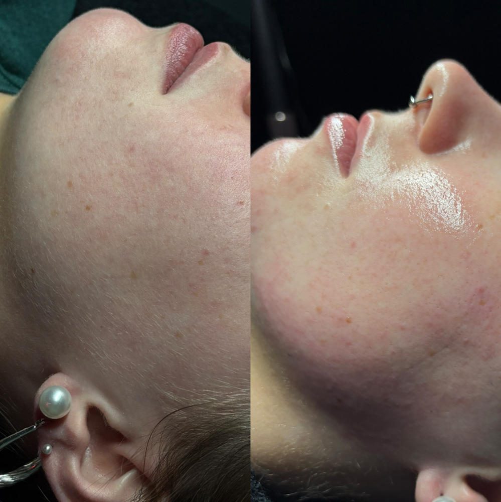 Dermaplane Dream Facial