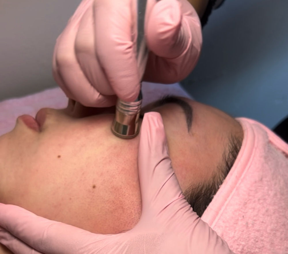 Microdermabrasion Facial