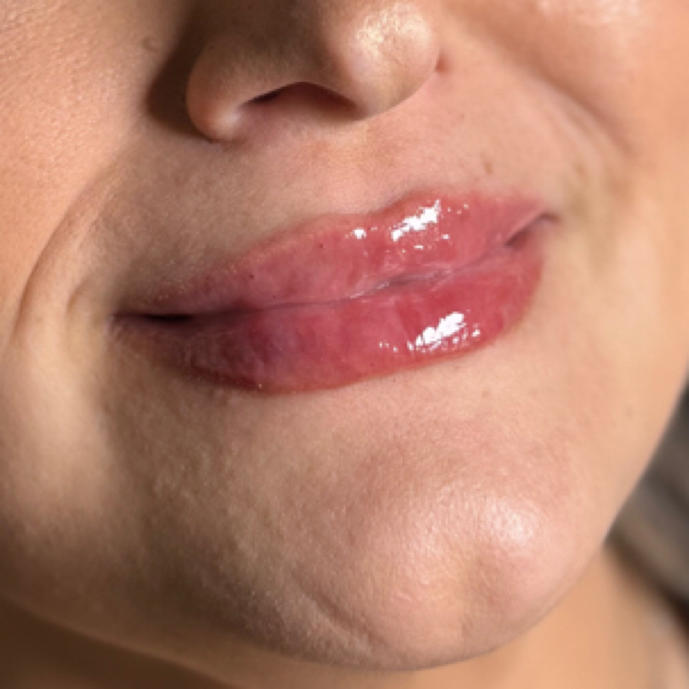 Lip Filler at Alira Aesthetics in McAllen, TX
