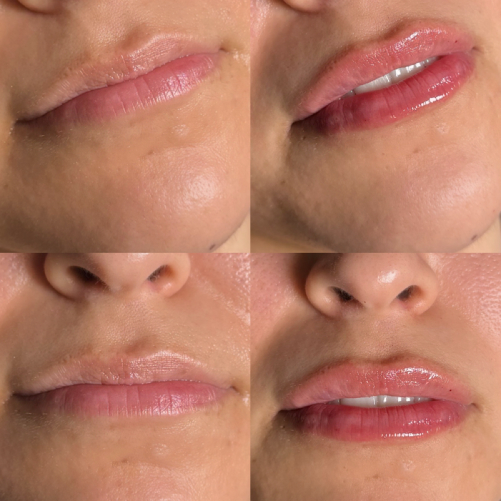 Lip Filler at Alira Aesthetics in McAllen, TX