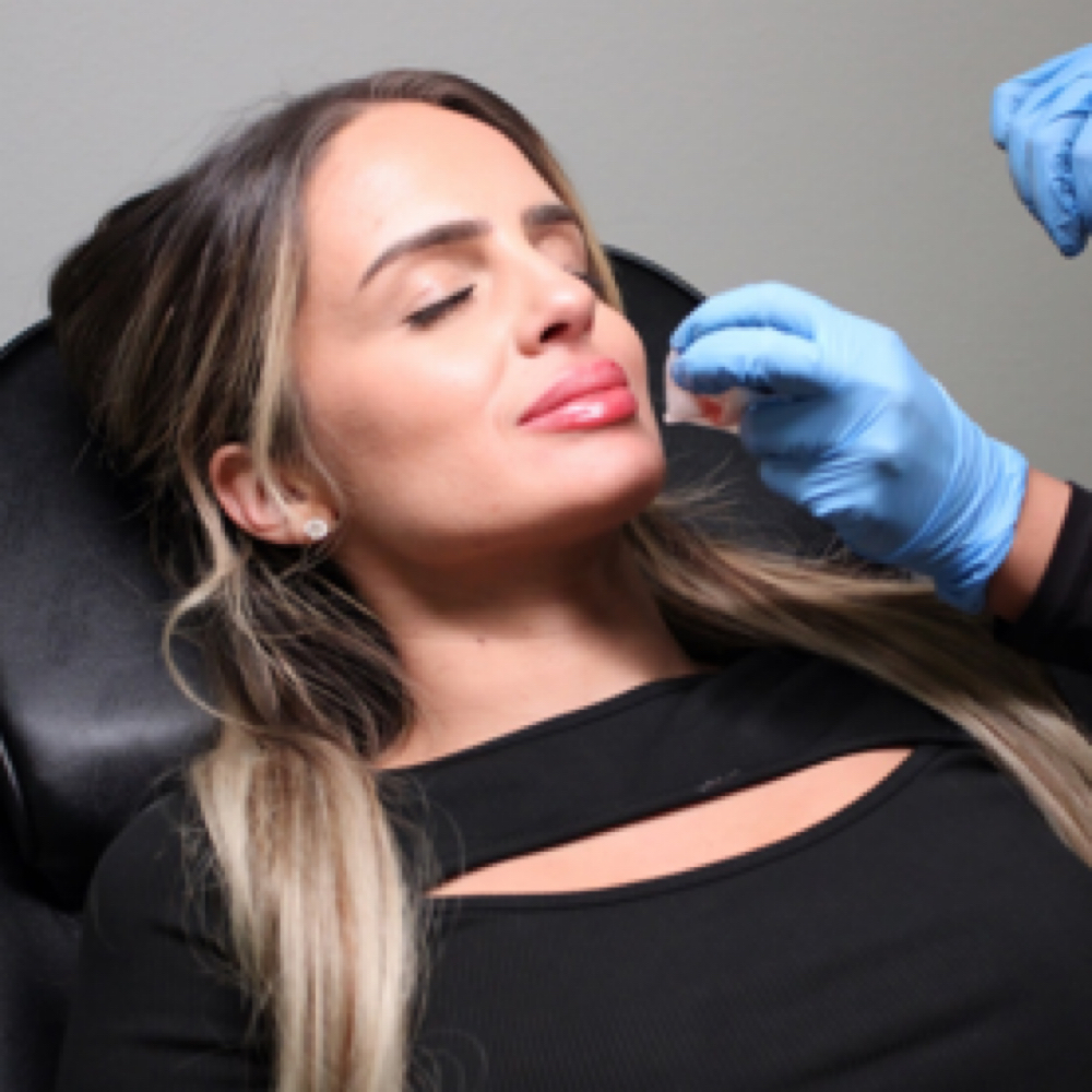 Lip Filler (RHA / Versa) at Alira Aesthetics in Mcallen, TX