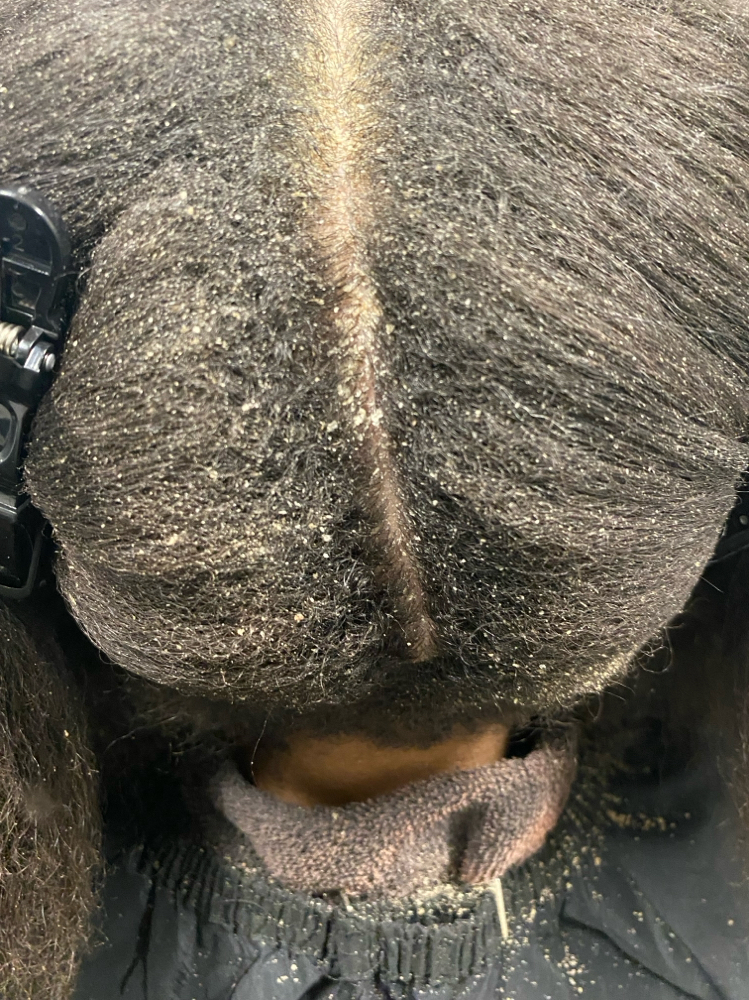 SCALP RESTORATION