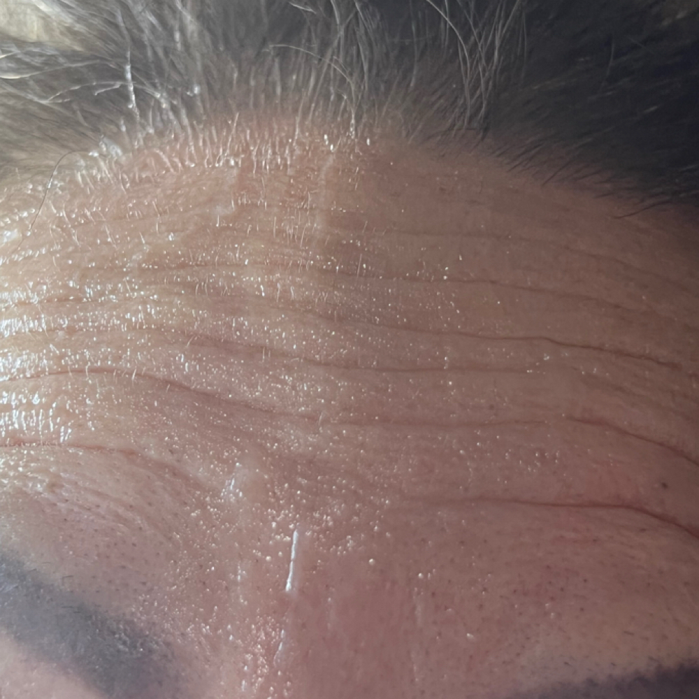 Botox upper face at Pure Bliss Studios in Fort worth, TX