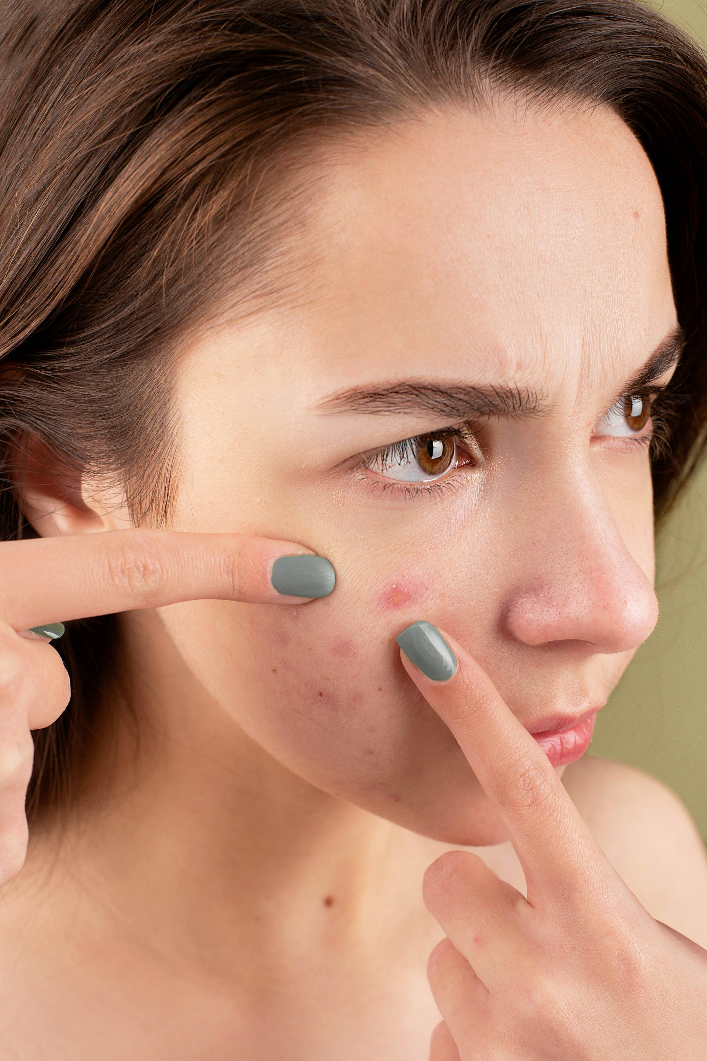 In-Clinic Acne Treatment