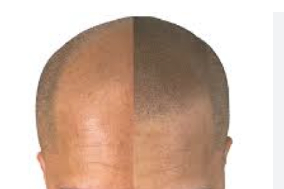 Scalp Micropigmentation 1/2 Head