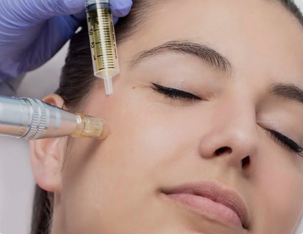 MICRONEEDLING/COLLAGEN INDUCTION