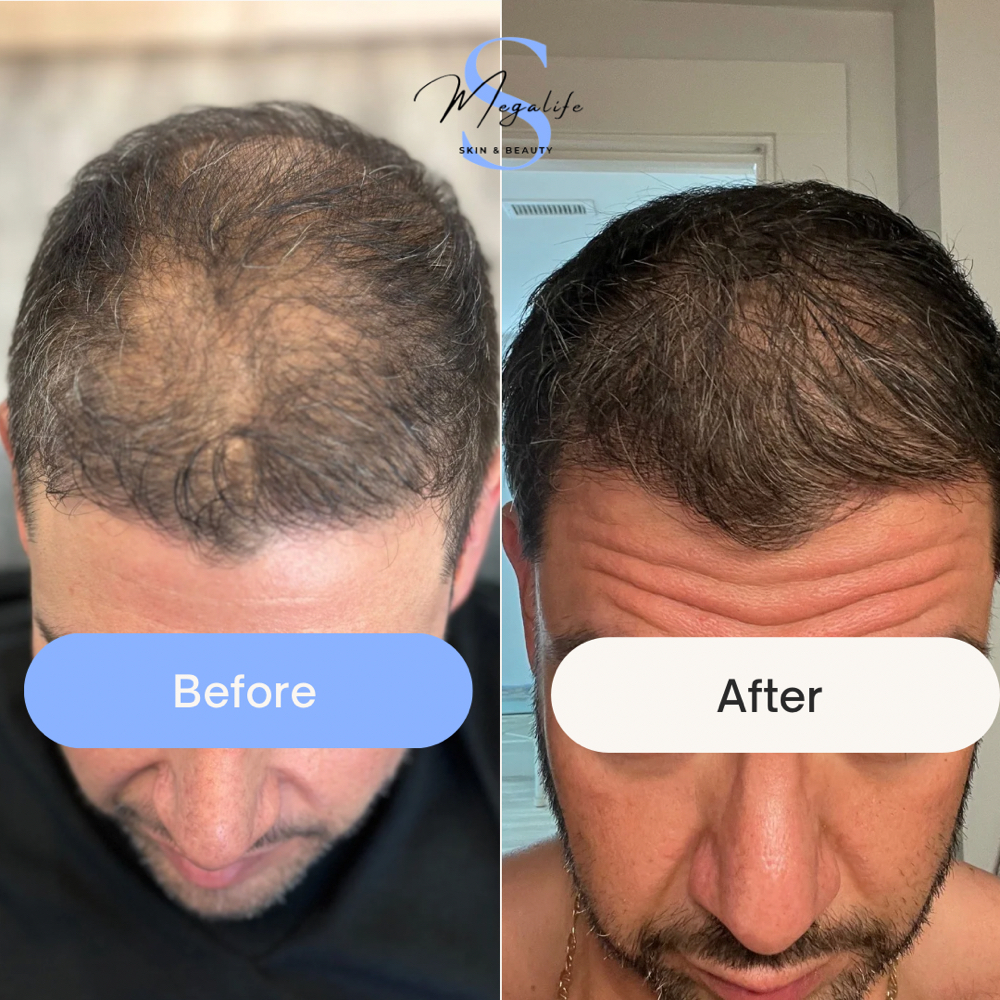 Hair Restoration Consultation at Megalife Skin & Beauty in Tempe, AZ
