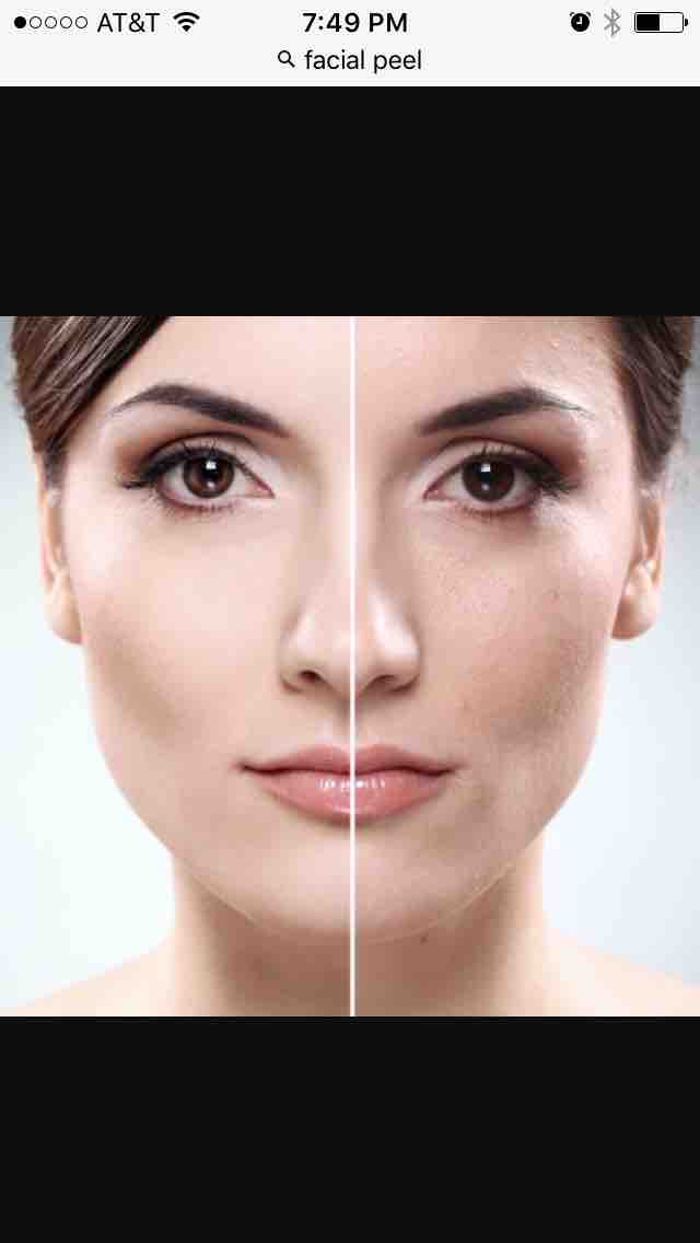 Ultra Peel 1
