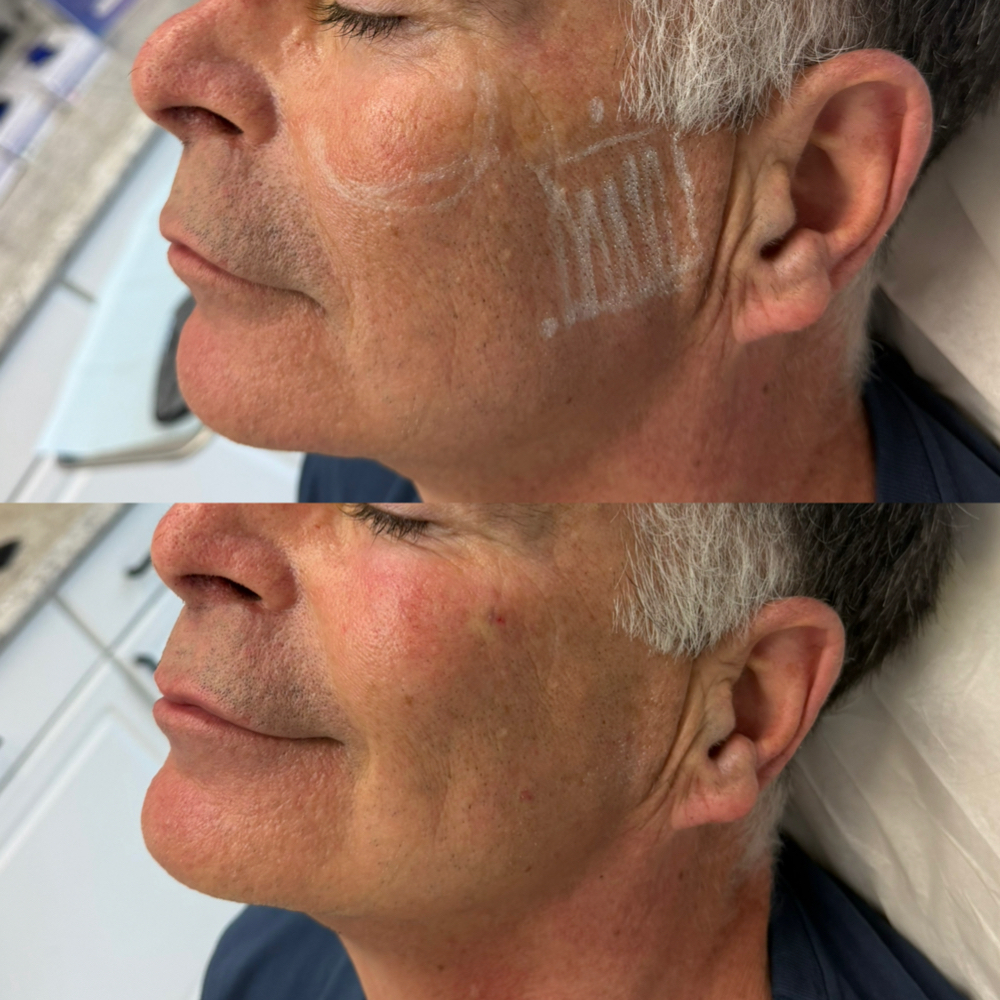 Mini Facial Balancing at Atelier Aesthetics and Infusions in Dallas, TX