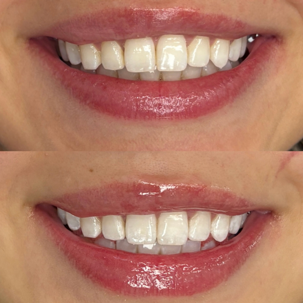 Quick Glow (Customized) at Luna Smiles in Lexington, SC