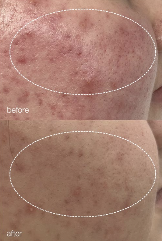 ProClear Treatment