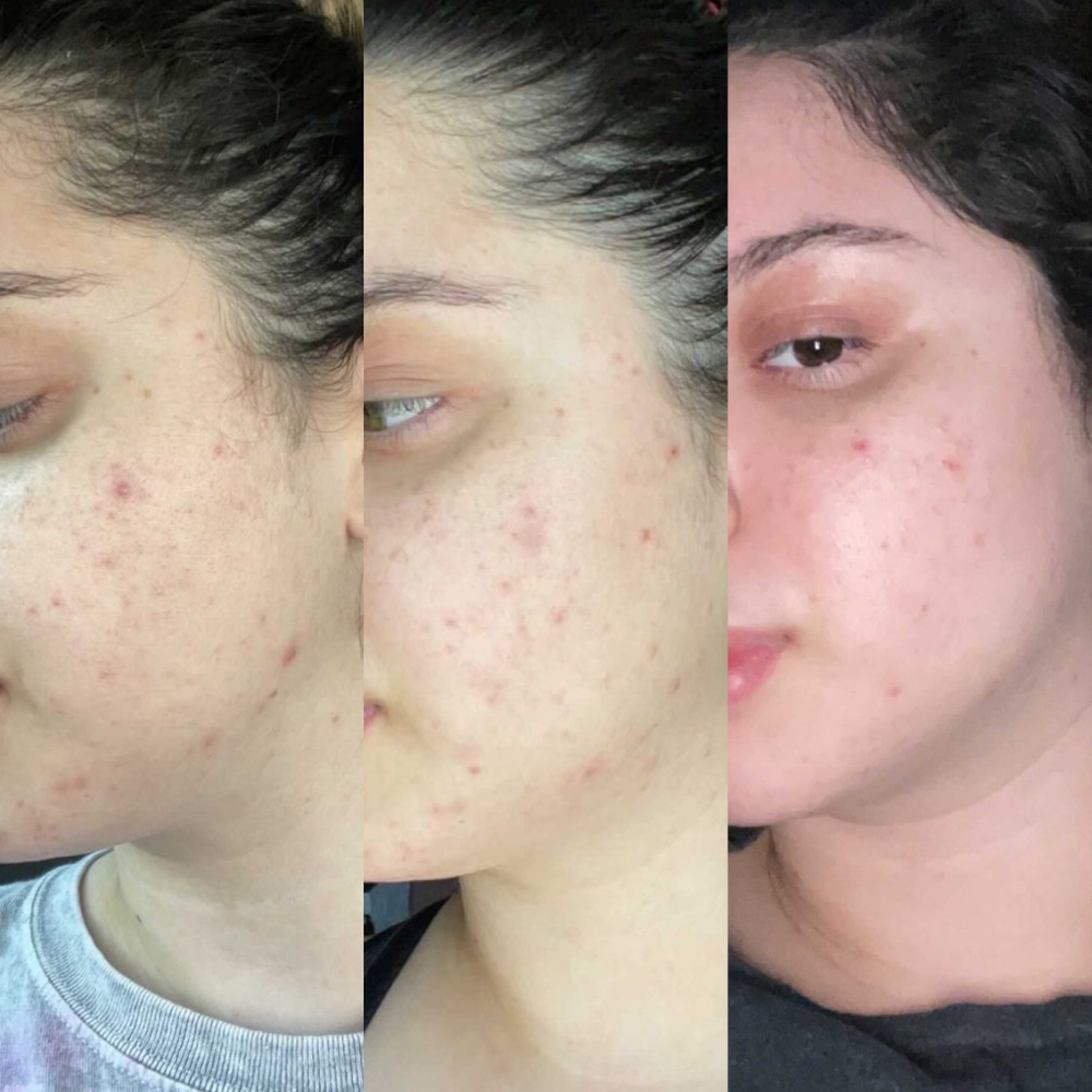 Acne 8 Week Series