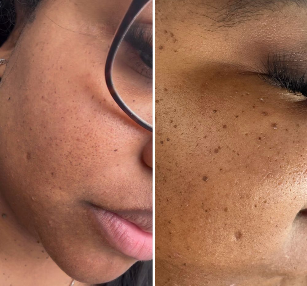 Skin Tag/Mole Consultation at LOOKATHER SKINBODY&LASHES AESTHETICS in Roswell, GA