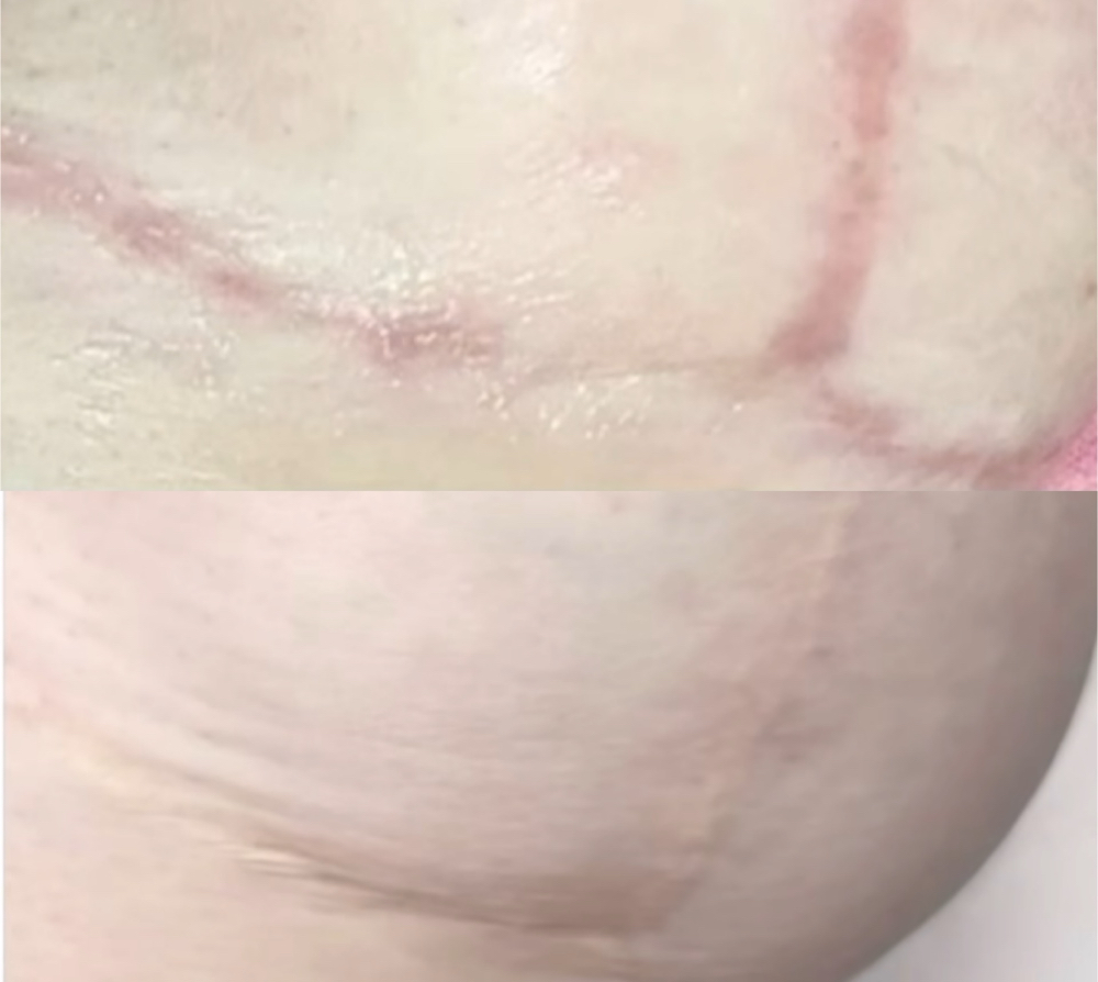 Breast Augmentation Restoration