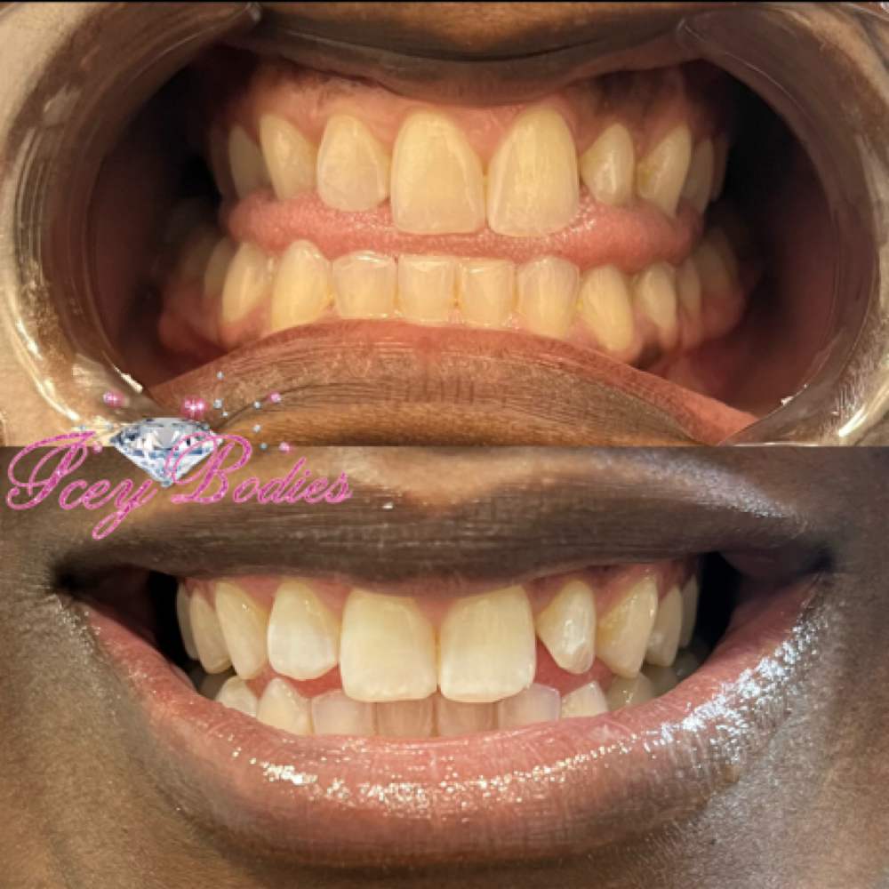 30 Minute Teeth Whitening at Icey Bodies in St Anthony, MN