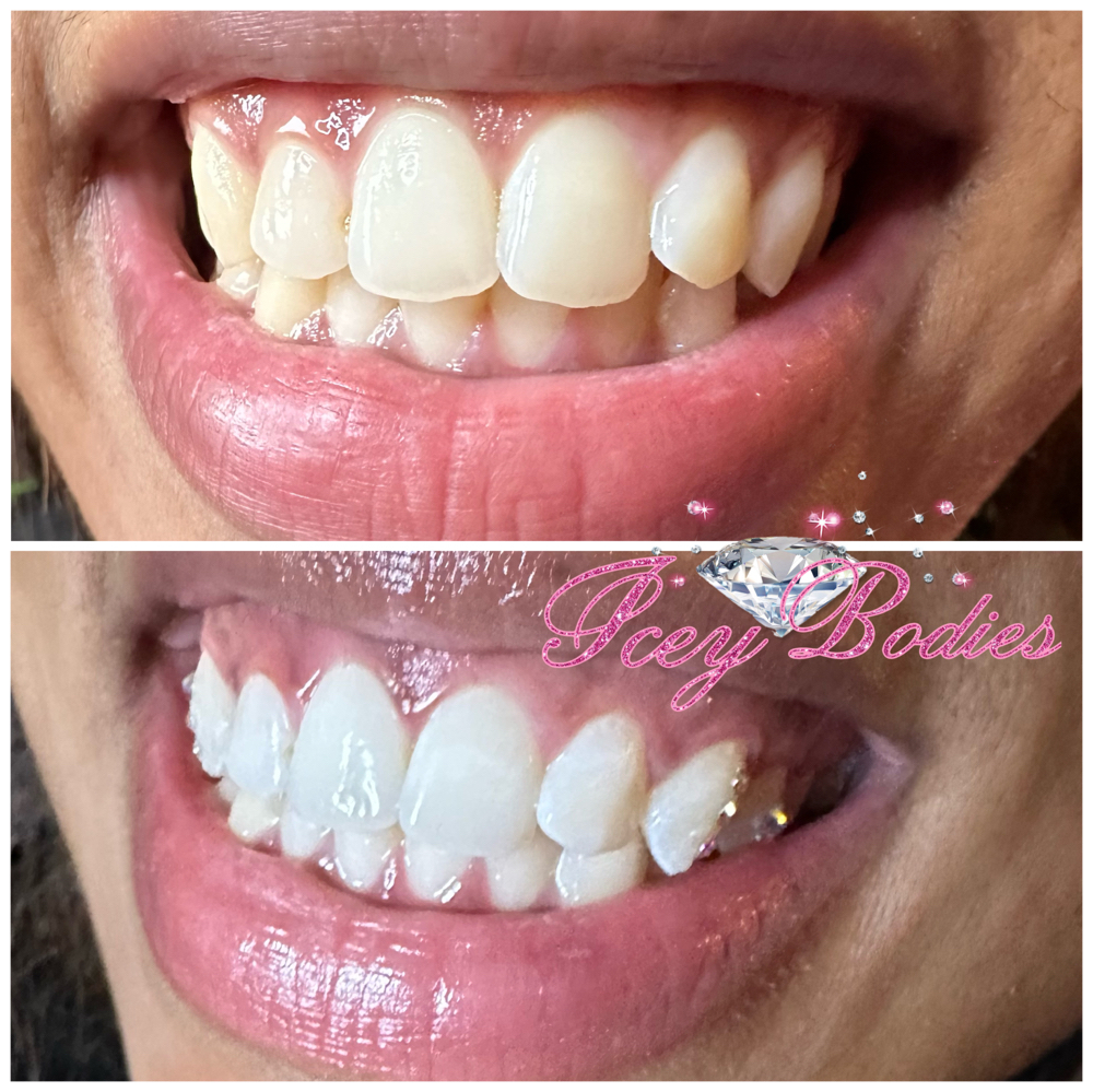 30 Minute Teeth Whitening Session