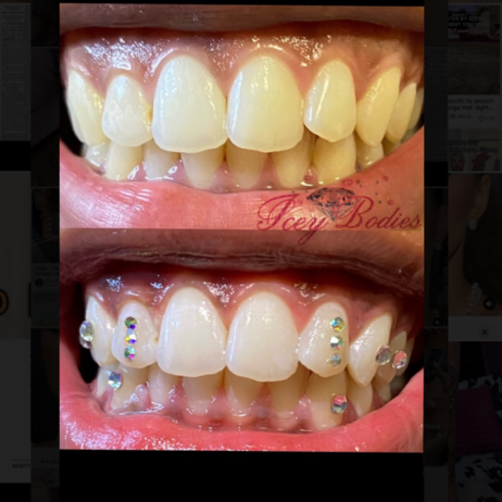 30 Minute Teeth Whitening at Icey Bodies in St Anthony, MN