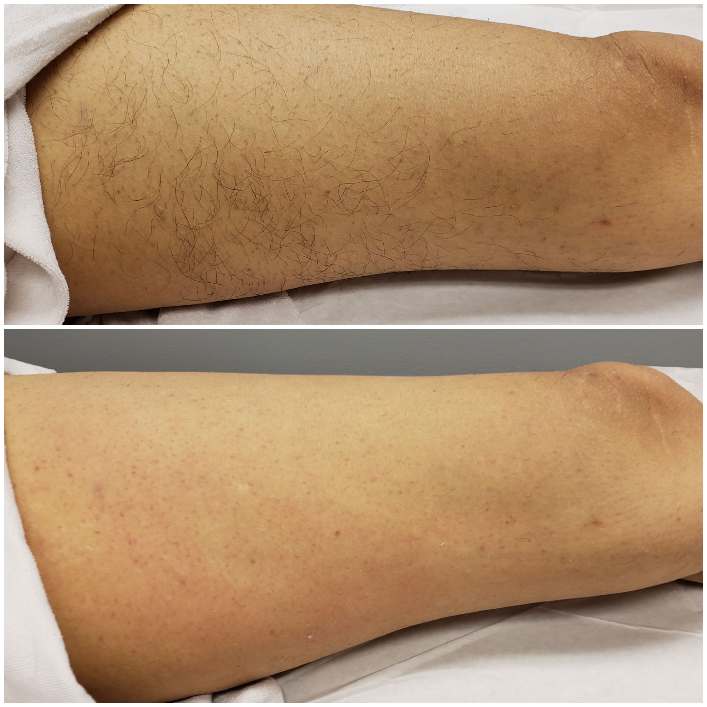 Full Leg Sugaring