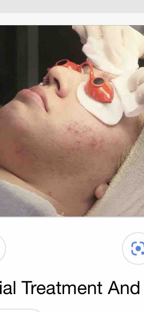 Acne Treatment And Extractions