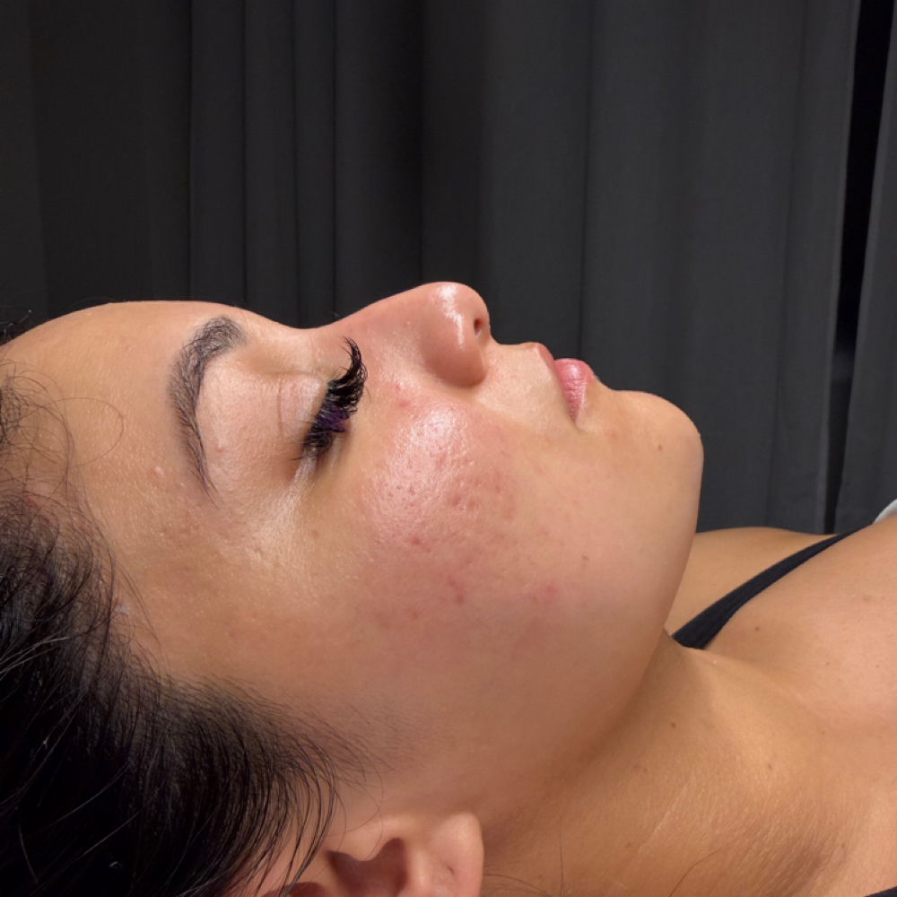 Express Reset Facial at Liv Beautiful Esthetics in CA, CA