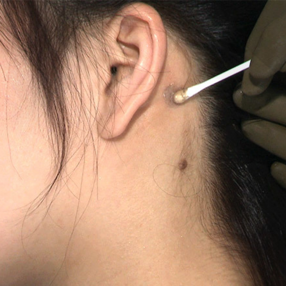 Patch Test at Eclipse Beauty Lounge in Denver, CO