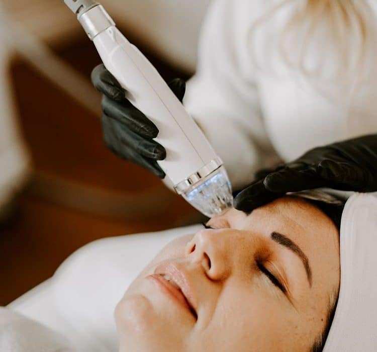 Microneedling with Radio Frequency