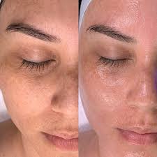 Hydrofacial W/ Dermaplane