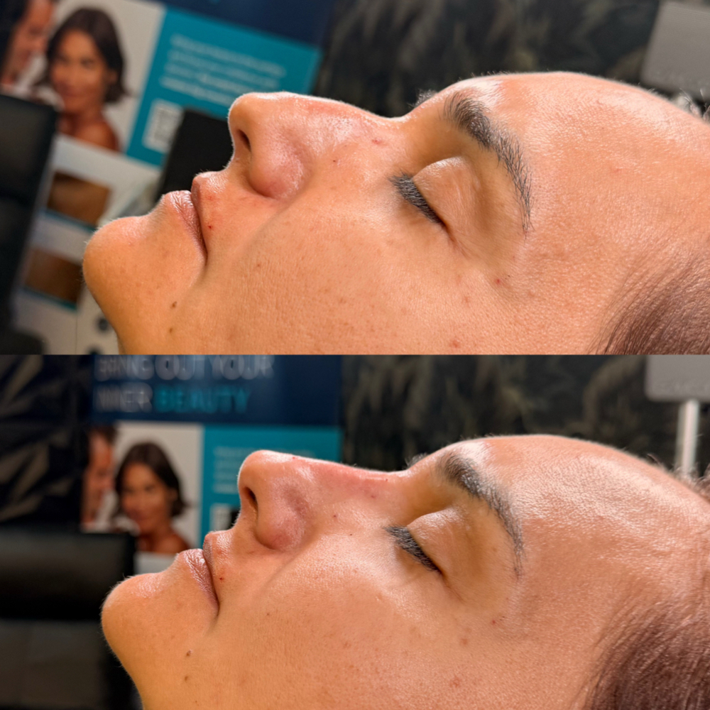 Nose Filler + Pixie Lift