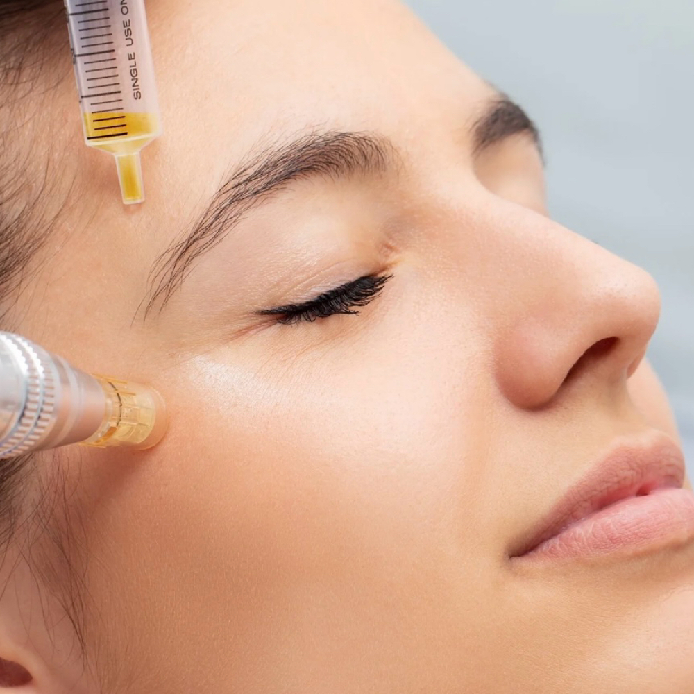 Platelet Rich Plasma (PRP)