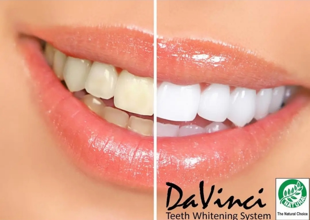 One Hour Teeth Whitening