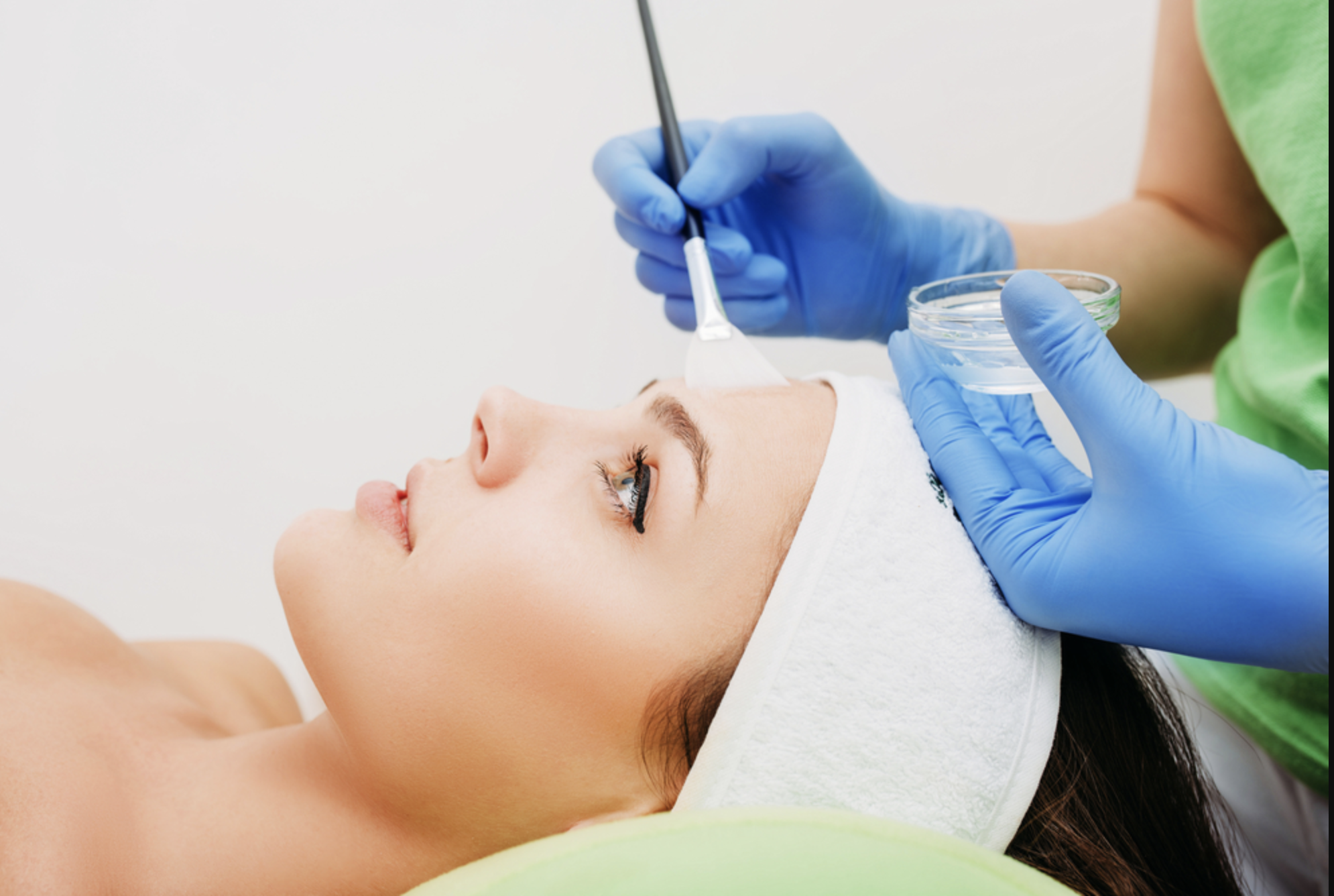 Chemical Peel