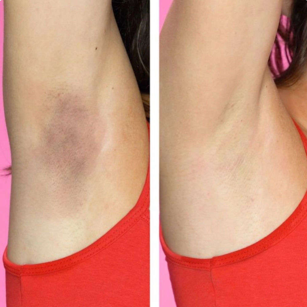 Skin Lightening Treatment at Glow on the Go in Converse, TX