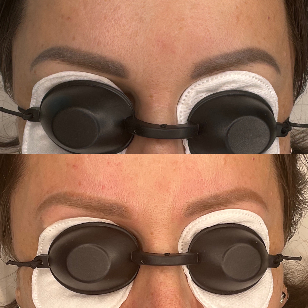 Leser Tatoo Removal