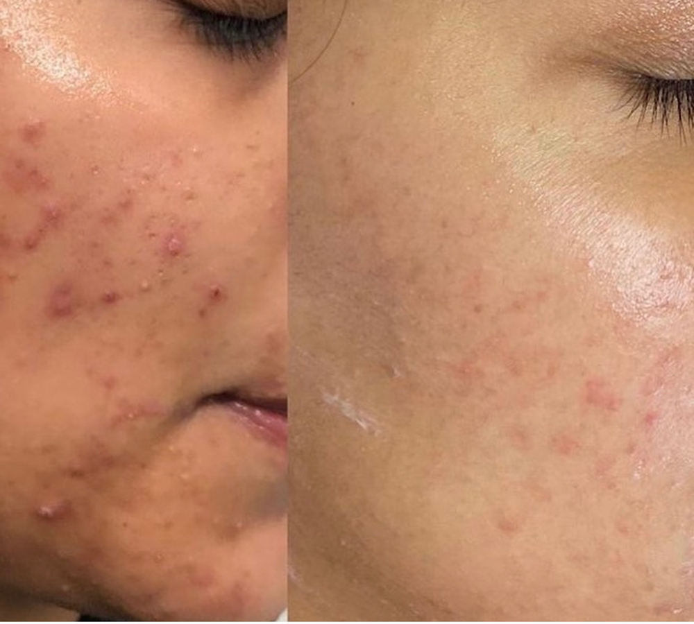 ACNE IPL TREATMENT