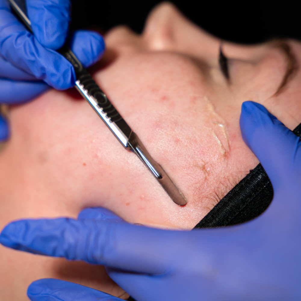 Dermaplane Add On at NuSkyn Studio in Dania, FL