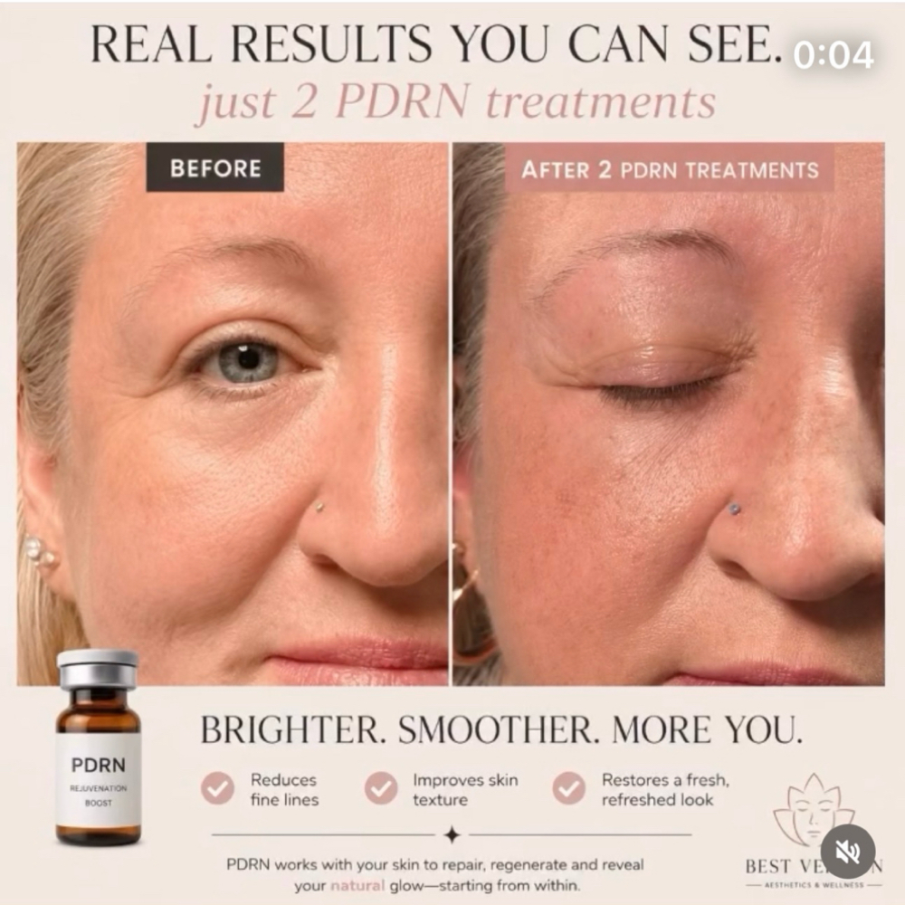 Under Eye Injections/Rejuvenation at Gracefully Refined Aesthetics in Payette, ID