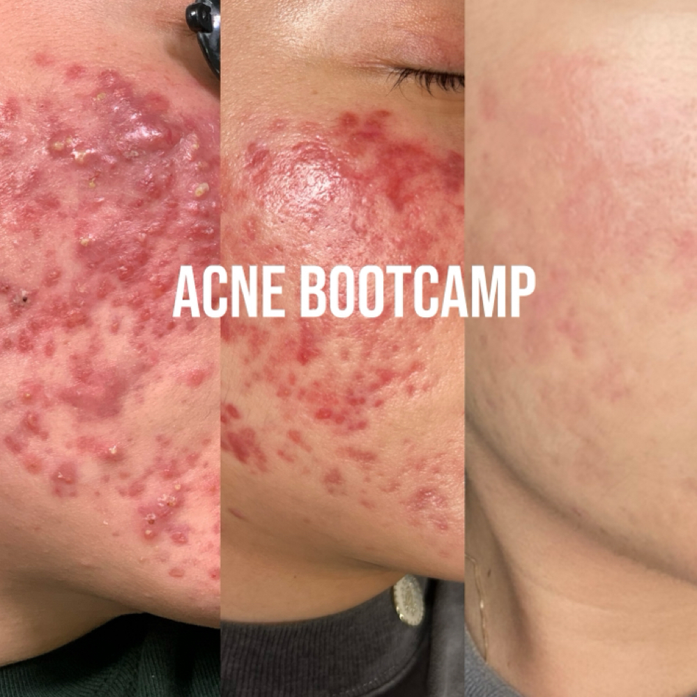 Acne Bootcamp Peel at Alchemy Skin in Lewisville, TX