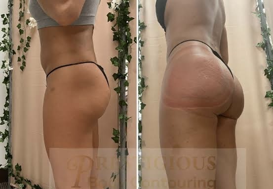 🍑 6 Sessions (Vacuum Butt Therapy)