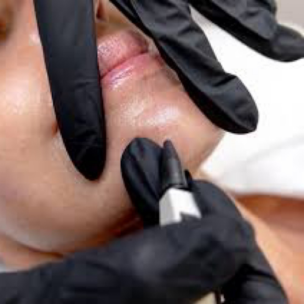Electrolysis Treatment | 60 Minutes at Elite Electrology in Medford, WI