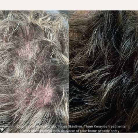 HydraScalp (Full Scalp) at All About You Beautique in Eugene, OR