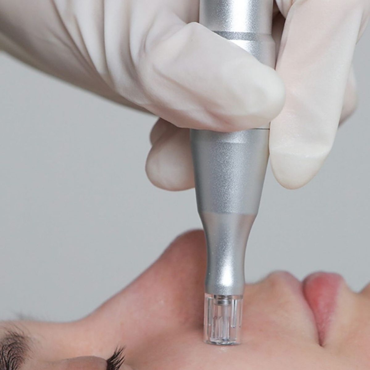 Nanoneedling Facial at STUDIO BLOOM in Lafayette, LA