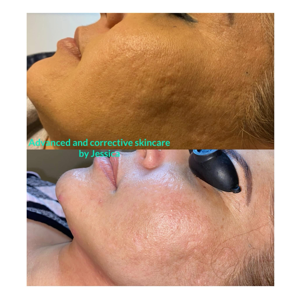 Bronze Glow • 3 Sessions at Advanced Skincare & Laser By Jess in Naples, FL