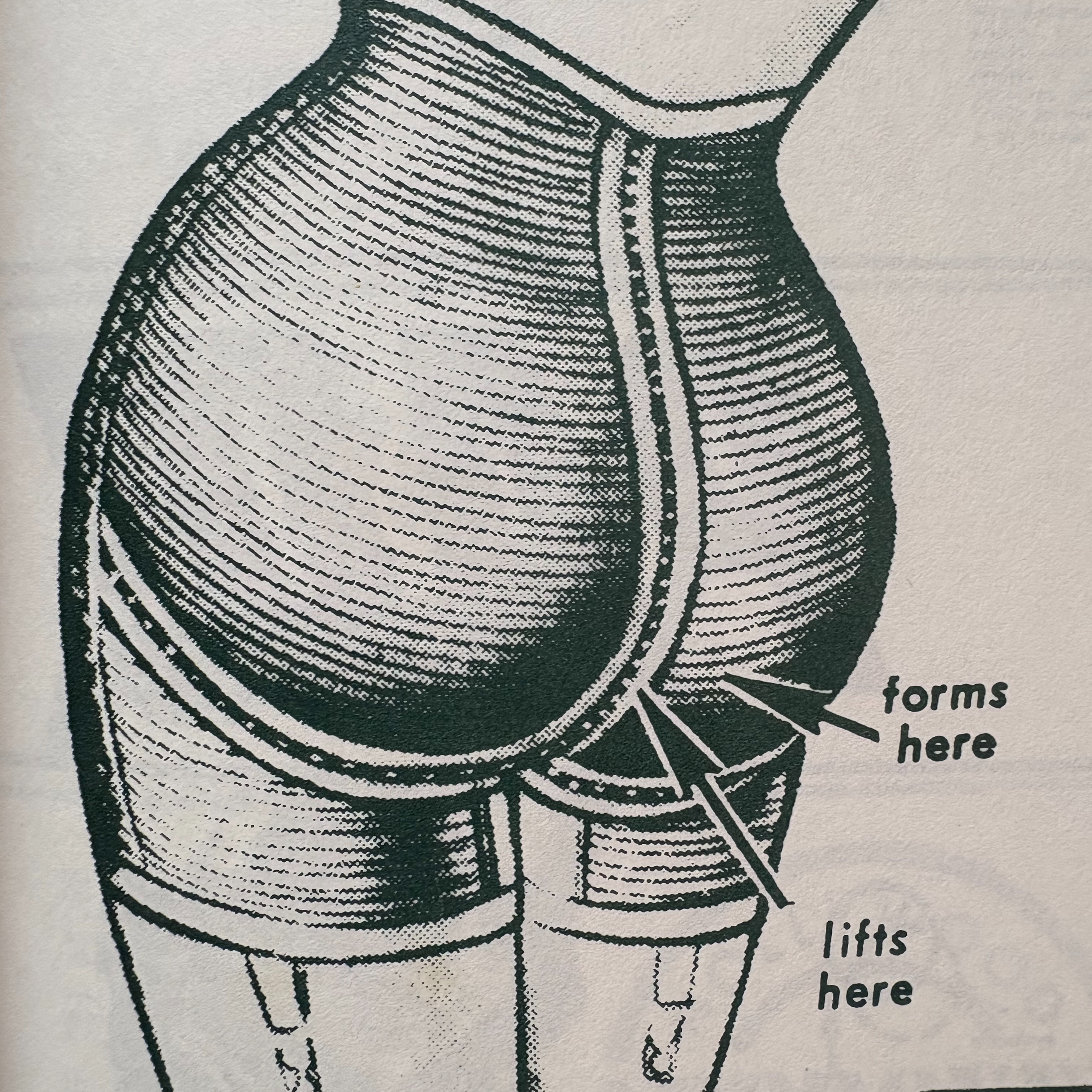 Butt Cheek Add on at Hot Peach Esthetics in Arcata, CA