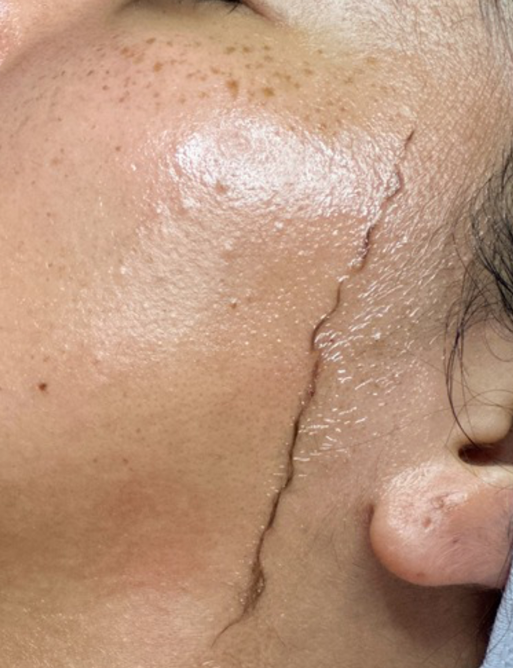 Dermaplane Facial