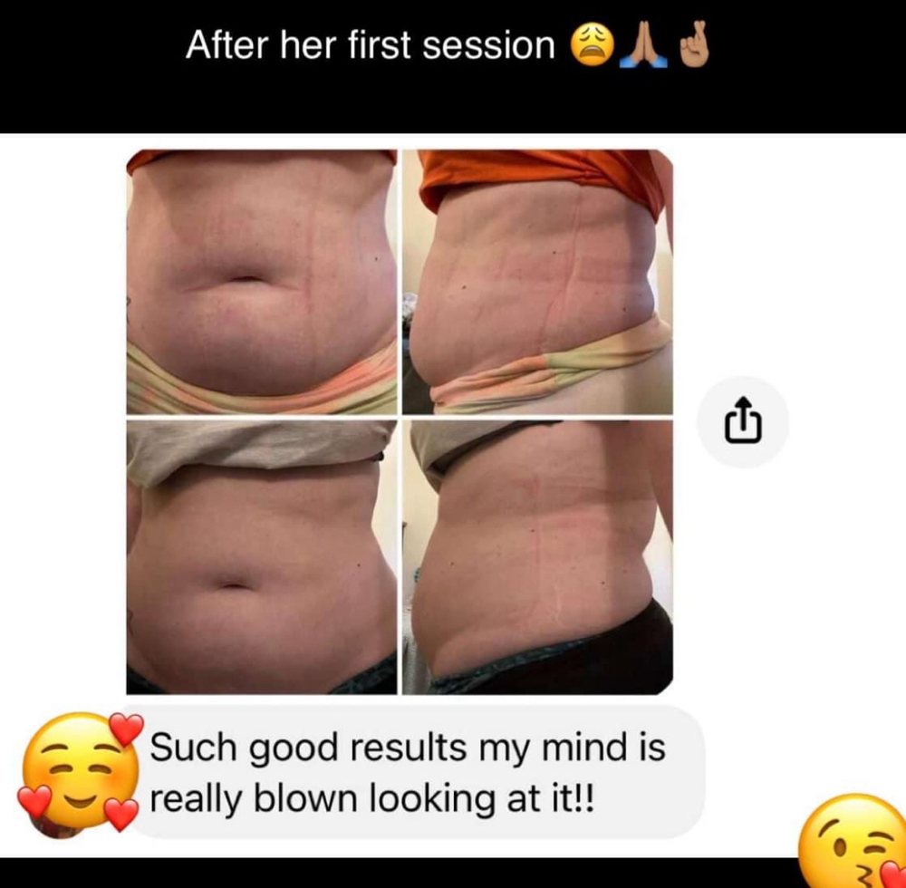 Skin Tightening at MarriGLoW in Sharon, PA