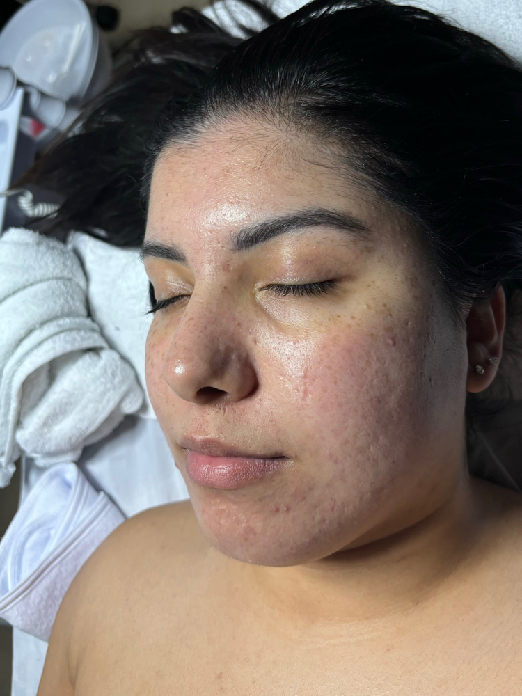 High frequency facial
